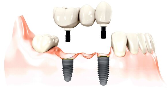 Dantų implantai.