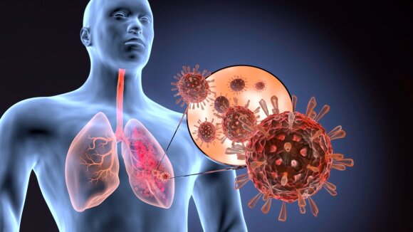 Effects of COVID-19 on the lungs