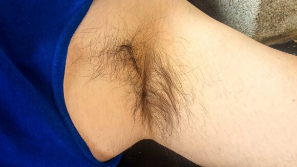 The doctor warned: increased body hair can be a sign of the disease.