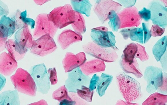 Gimdos kaklelio ląstelės citologinio tyrimo metu