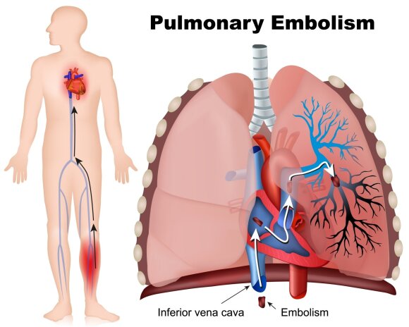 Pulmonary embolism