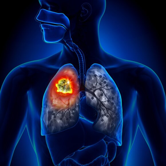 Plaučių vėžys