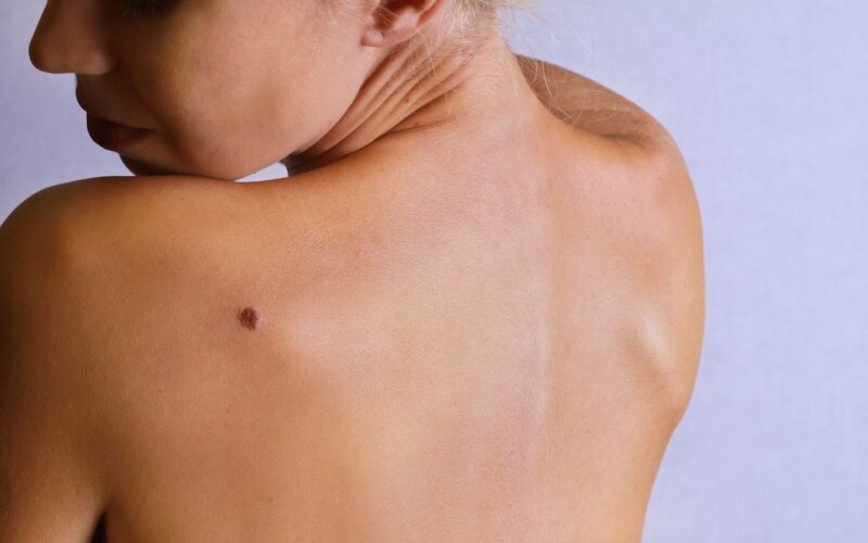 melanoma