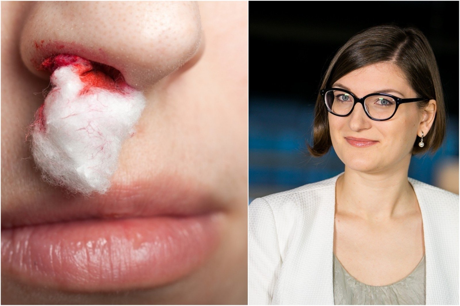 Kokios priežastys yra kraujavimas iš nosies?